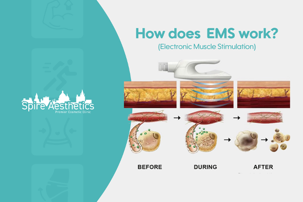 EMS treatment for post pregnancy weight loss treatment Bournemouth