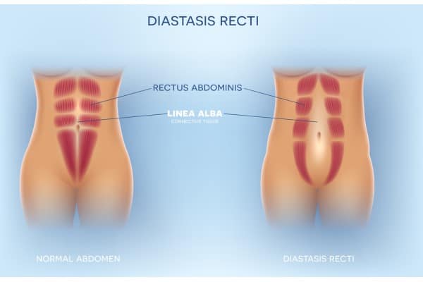 What Non-Surgical Options Are Available for Diastasis Recti Bournemouth?