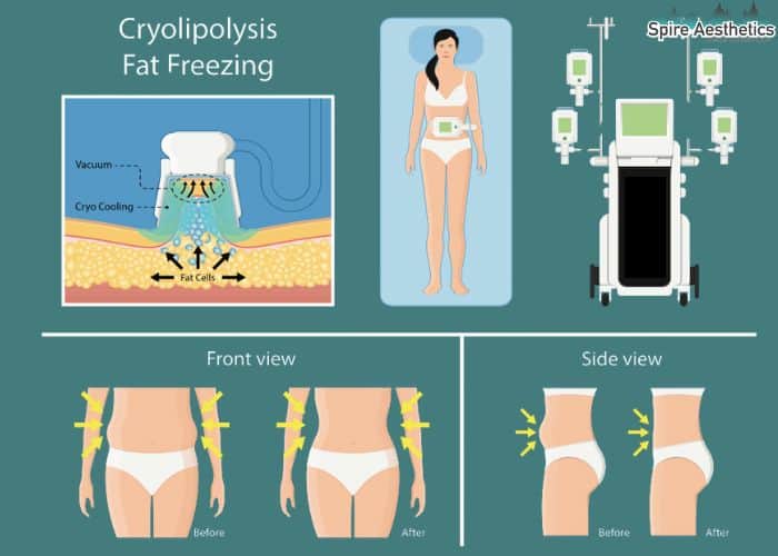 Image of diet and fat freezing combined for best results for Spire Aesthetics Bournemouth