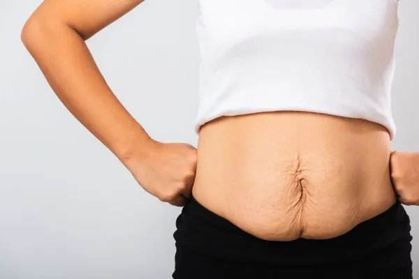 Image of a woman's stomach after weight loss with sagging skin following a gastric band Bournemouth