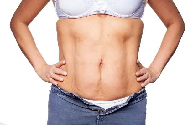 sagging skin on woman's stomach after weight loss injections Bournemouth