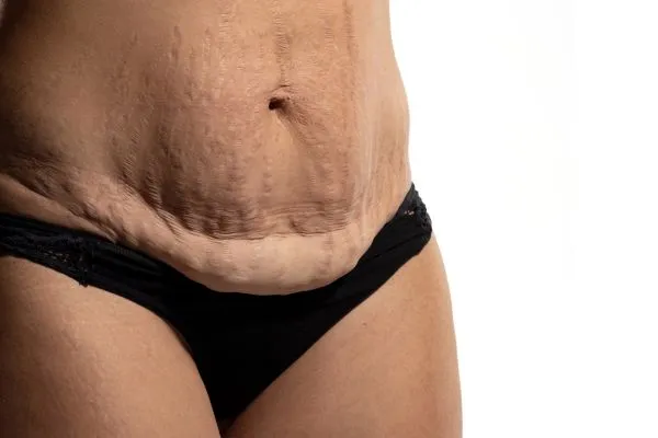 Image of womans stomach after weight loss injections Bournemouth showing saggy skin