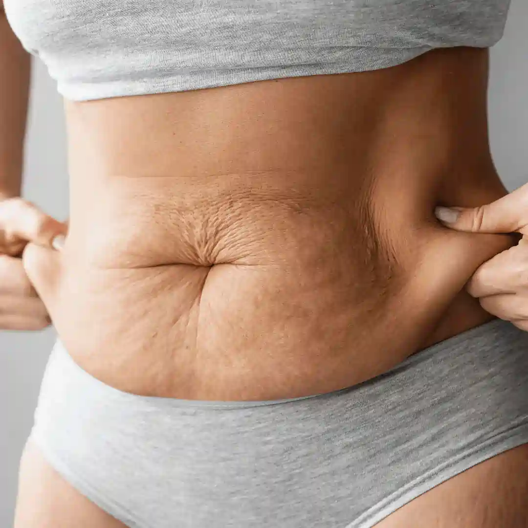 Is It Normal to Have Loose Skin After Pregnancy Bournemouth?
