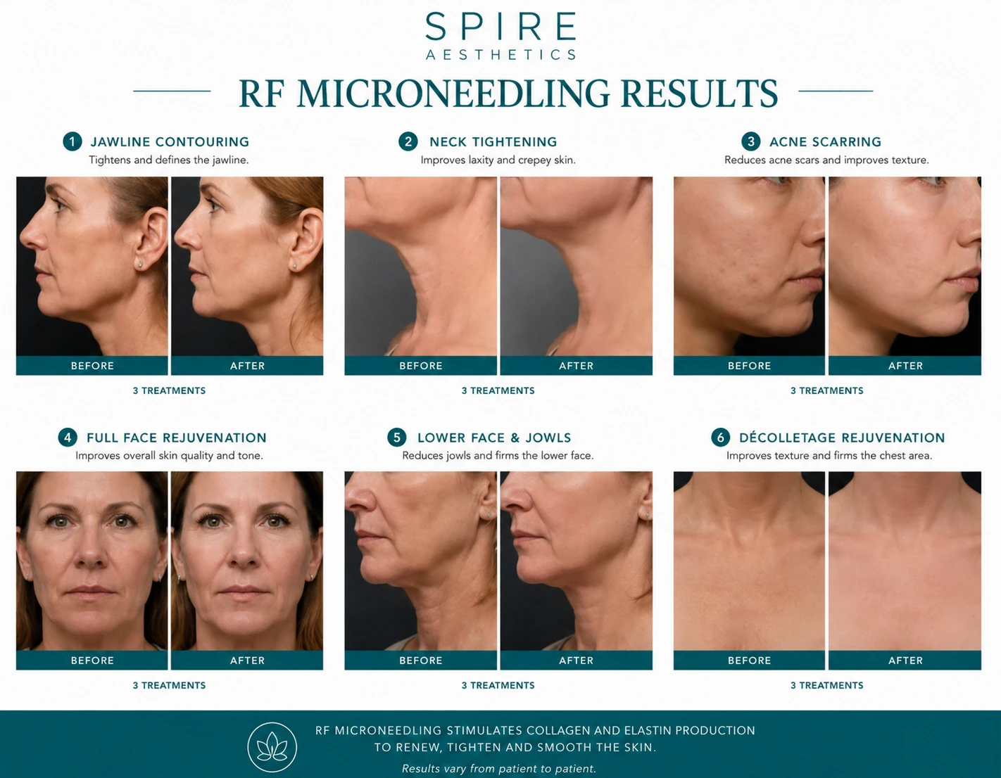 RF Microneedling Skin tightening Bournemouth results
