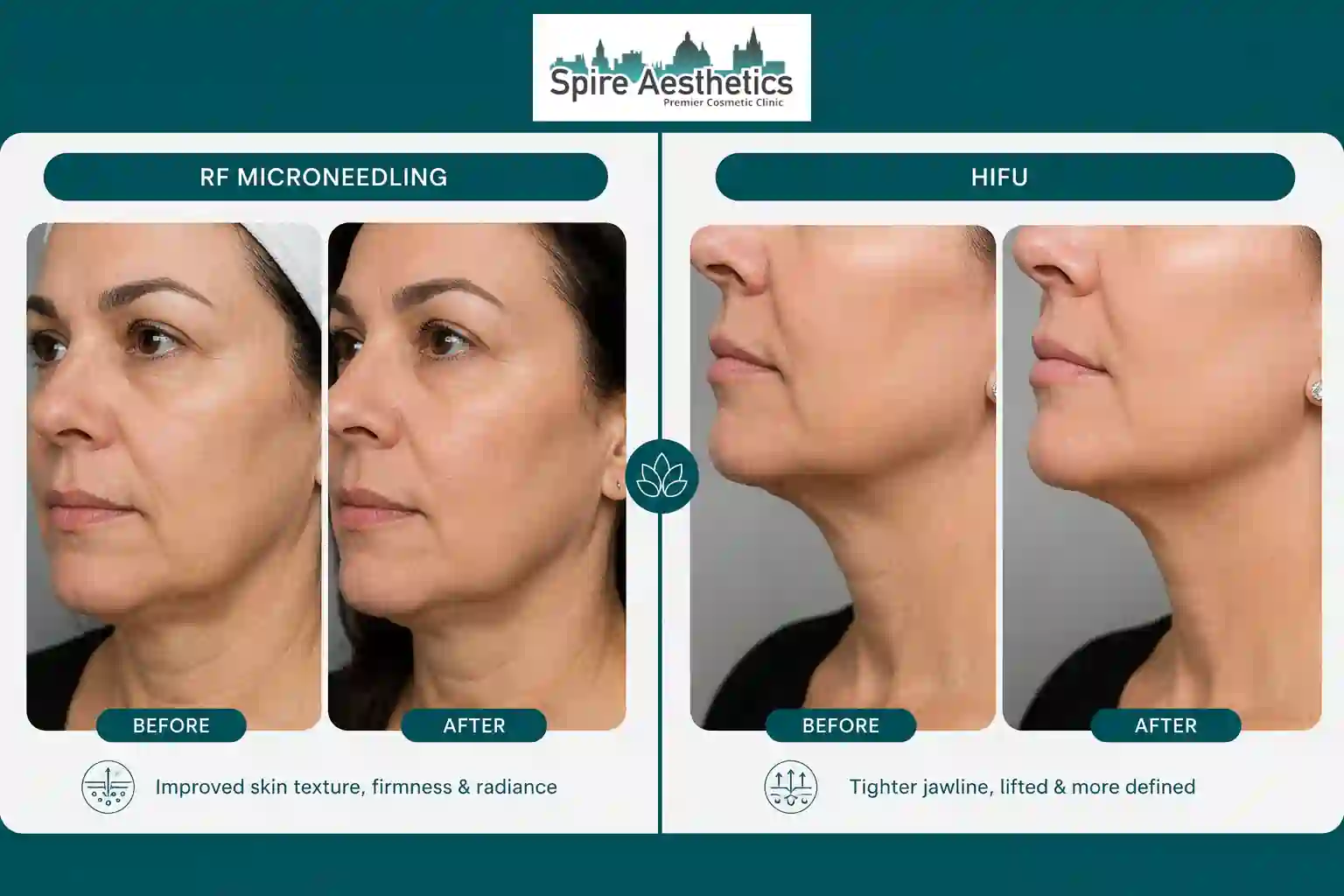 Can RF Microneedling and HIFU Be Combined Bournemouth?
