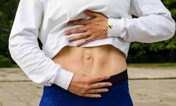When Could Diastasis Recti Be the Missing Piece of the Puzzle Bournemouth?