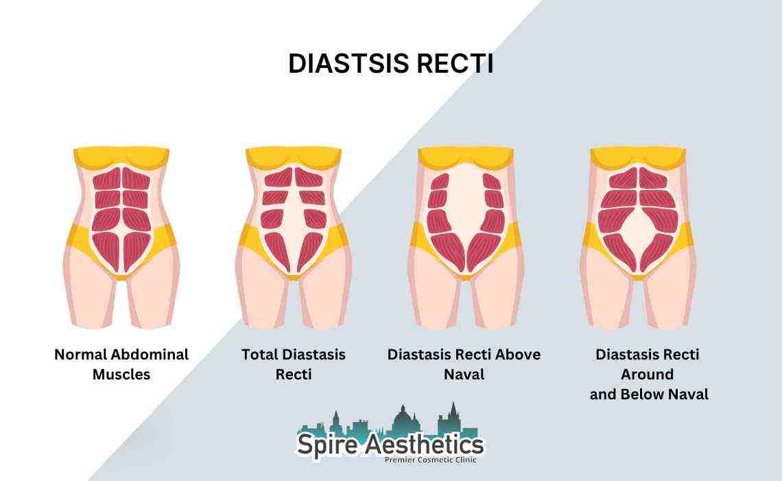 Is Non-Surgical Diastasis Recti Treatment Right for You? Common Concerns Answered Bournemouth